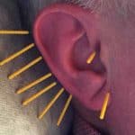 akupunktur rokavvanjning